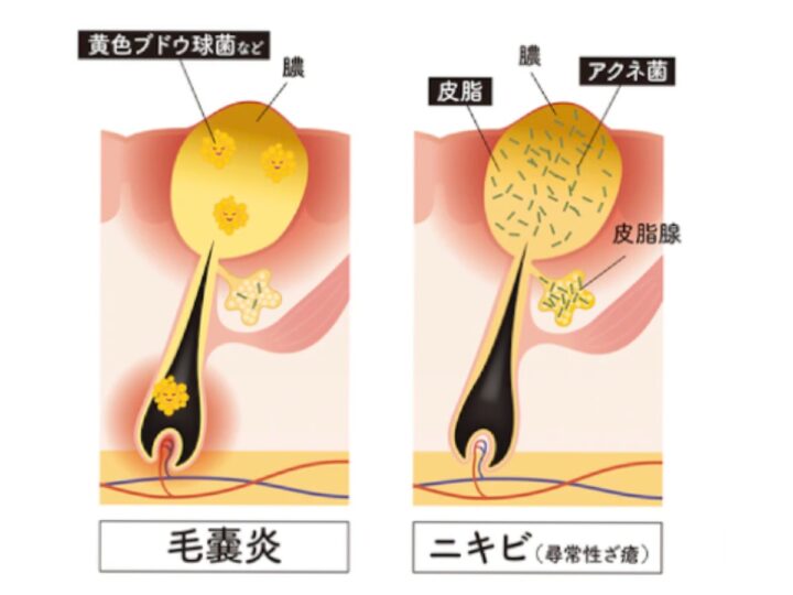 メンズ脱毛後にできるニキビのようなものは毛嚢炎！？の画像