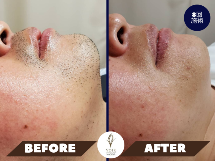 ヒゲ脱毛で、剃り跡の影を目立ちにくくの画像